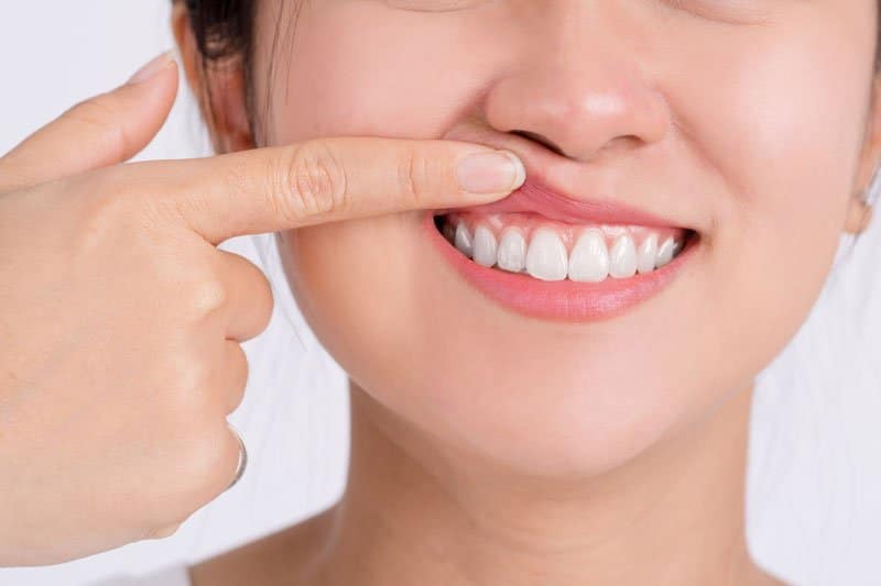 paintient with a new smile, Dental Bonding