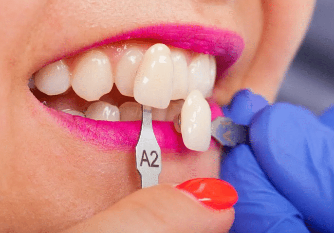 Cosmetic 1024x683 1, Dental Bonding