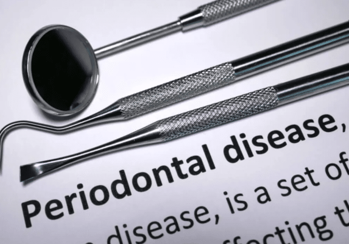 periodontal 1024x729 1 1, Periodontal Disease Treatment