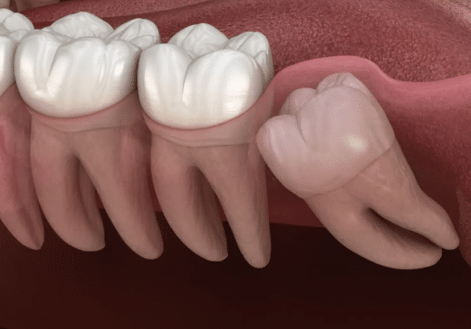 wisdom teeth 1024x729 1, Tooth Extractions