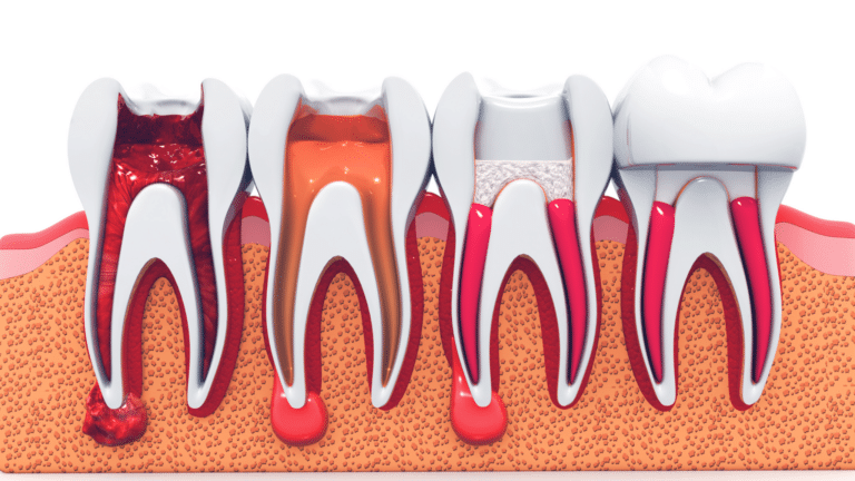 76, Root Canal Warning Signs: When to Seek Professional Dental Care