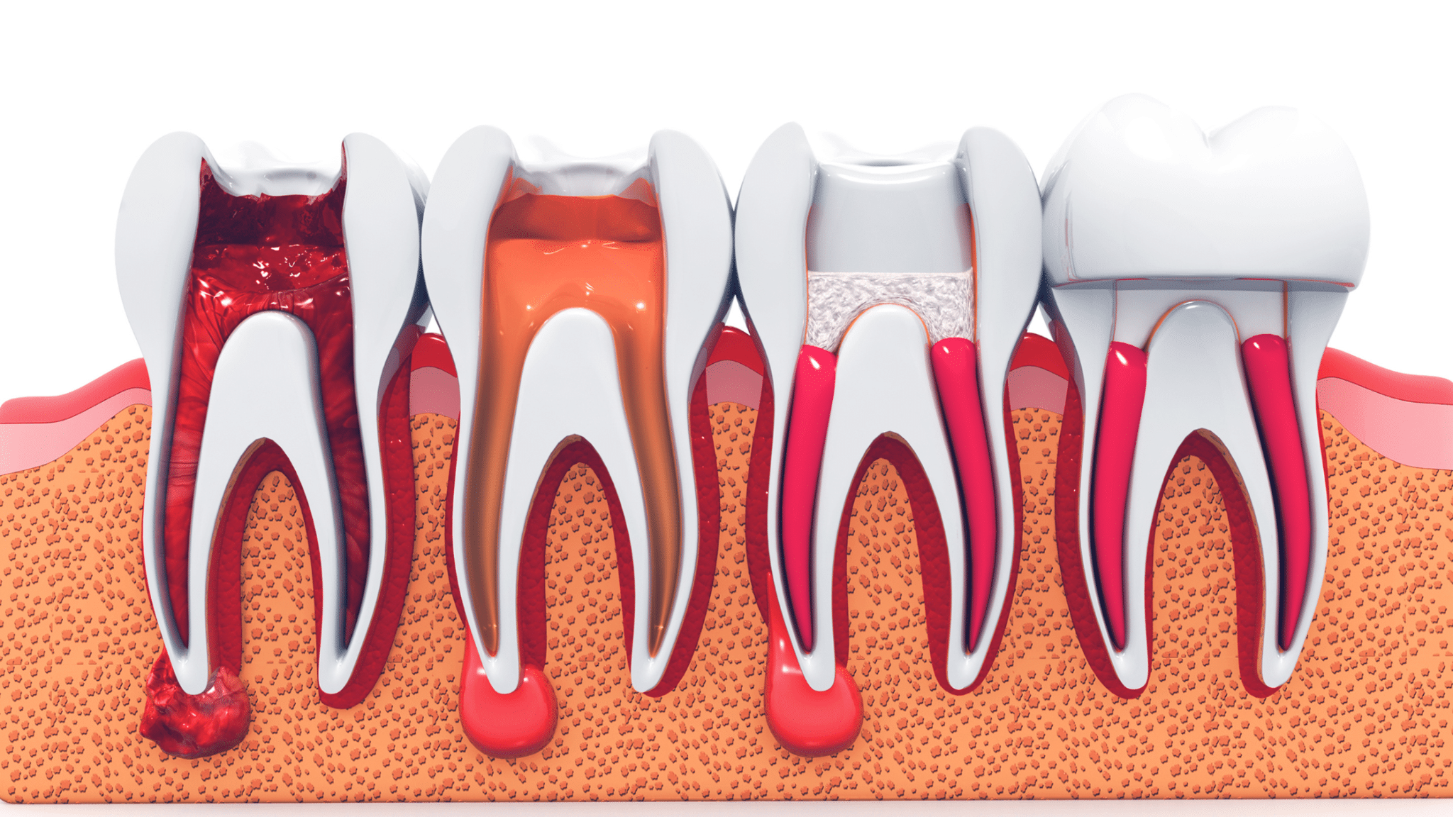 Photo for Root Canal Warning Signs: When to Seek Professional Dental Care