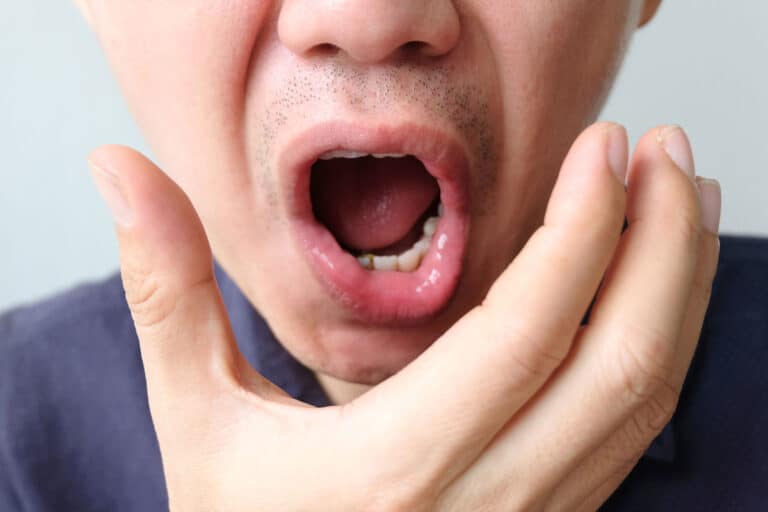 A man with his mouth wide open, How to Heal Cuts in the Mouth: Effective Remedies