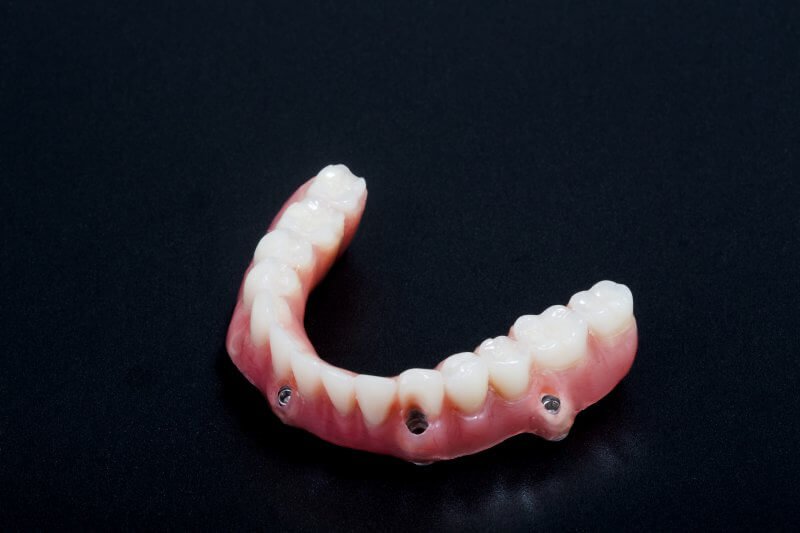 Photo for How Dental Implants in Harris County Make Your Dentures Permanent