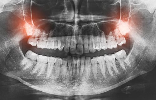 AdobeStock 131976161 1506713311 401641, Your Dentist in Harris County Explains Why We Have Wisdom Teeth