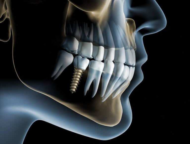 AdobeStock 27078844 1521567473 860331, How Many Teeth Can Dental Implants in Harris County Replace?