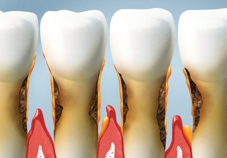 AdobeStock 60211674 1024x7131 1, Your Dentist Explains the Causes of Receding Gums