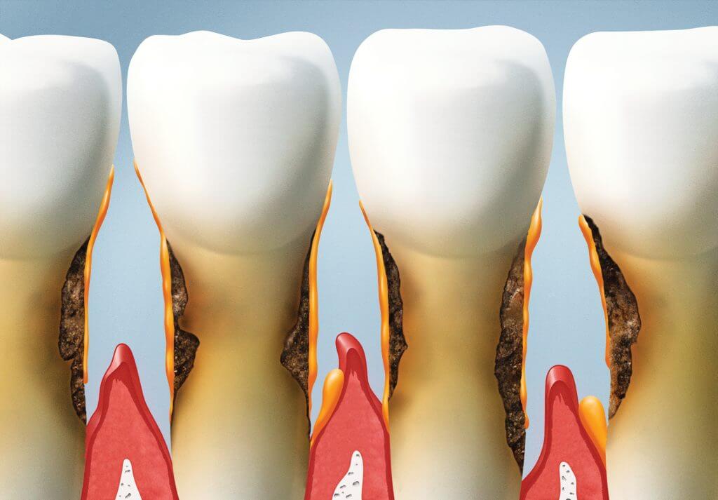 Photo for Your Dentist Explains the Causes of Receding Gums