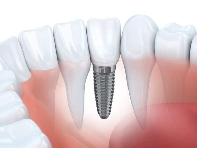 AdobeStock 71502762 1525278959 429231, How Do Dental Implants in Hamilton Function Inside the Body?
