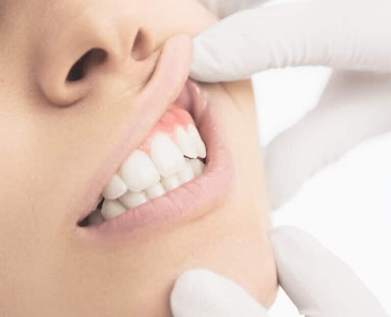 AdobeStock 84742781 1547243476 424731, The 4 Stages of Tooth Decay in Harris County