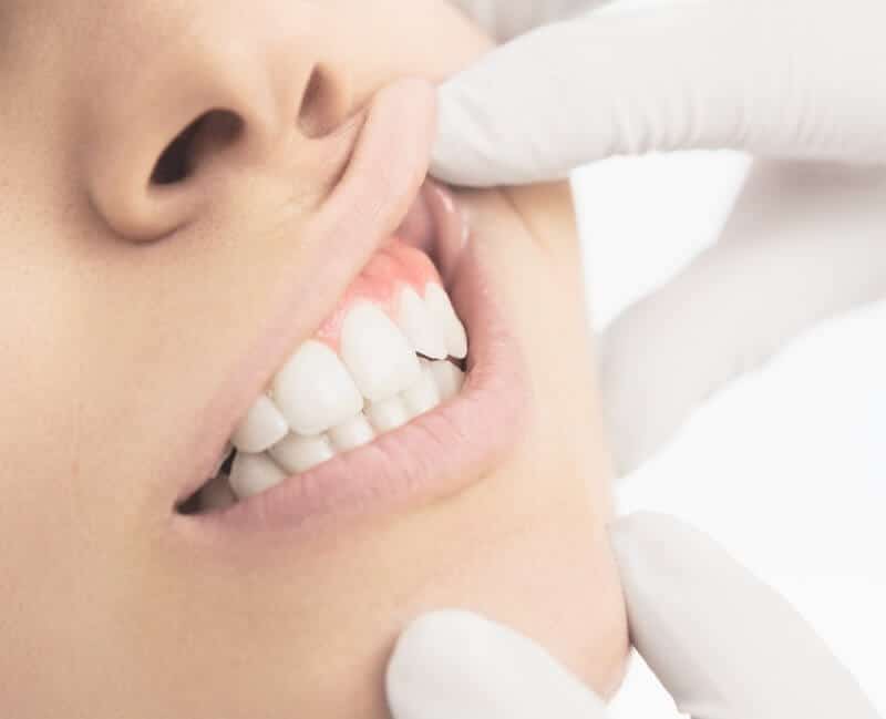 Photo for The 4 Stages of Tooth Decay in Harris County