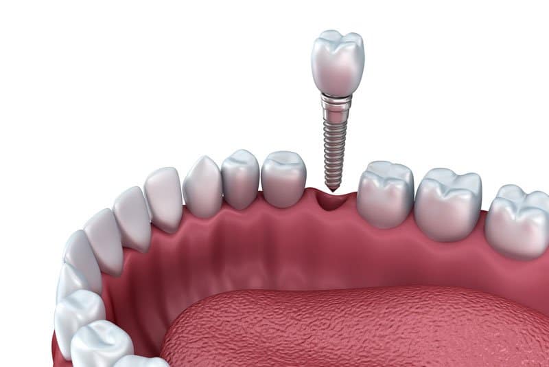 Photo for Why Choose Dental Implants To Replace Teeth?