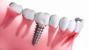 Photo for Is Getting Dental Implants Painful? Find Out What To Expect Here