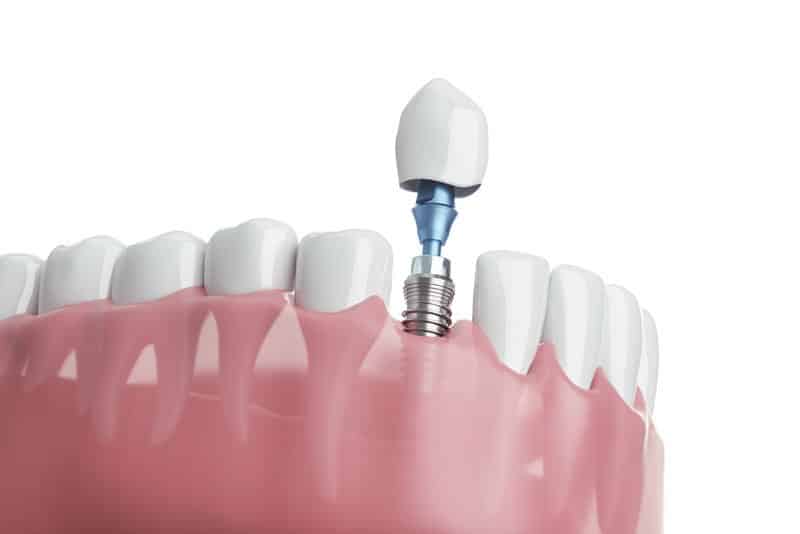 Photo for Want Dental Implants In Hamilton, GA? We Can Determine Your Candidacy For Them