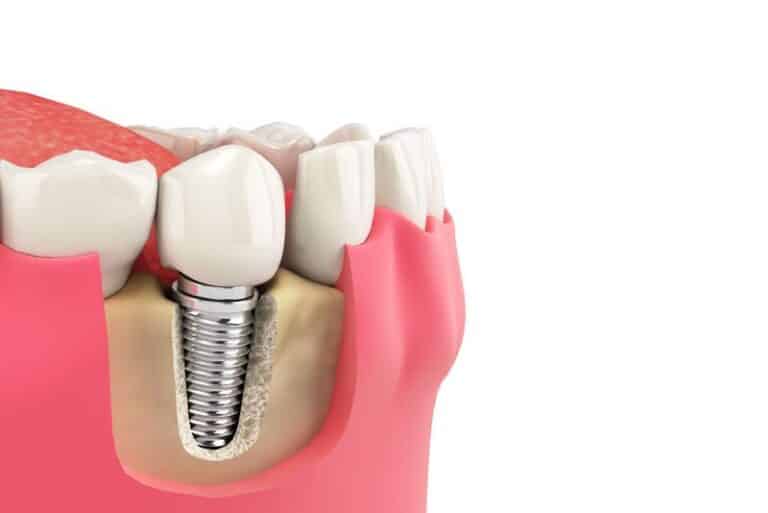 a single dental implant in a jawbone model, How Do Dental Implants Improve My Smile?