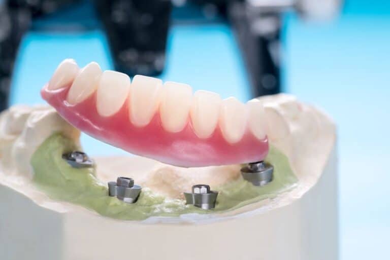 an implant supported denture model all on four implant posts, Will My Smile Be Stable And Comfortable With Implant Supported Dentures?