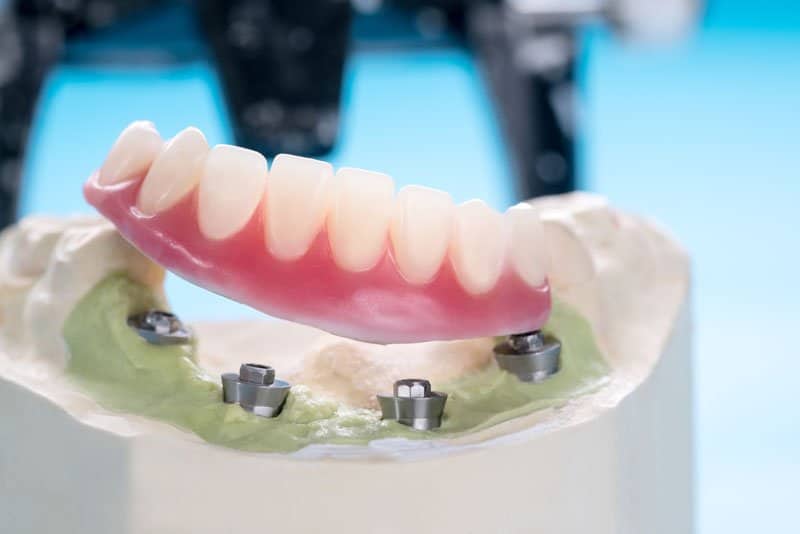 Photo for Will My Smile Be Stable And Comfortable With Implant Supported Dentures?
