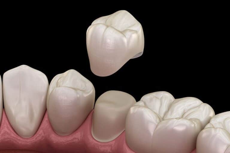 dental crowns model, Will My Smile Improve With Dental Crowns In Hamilton, GA?