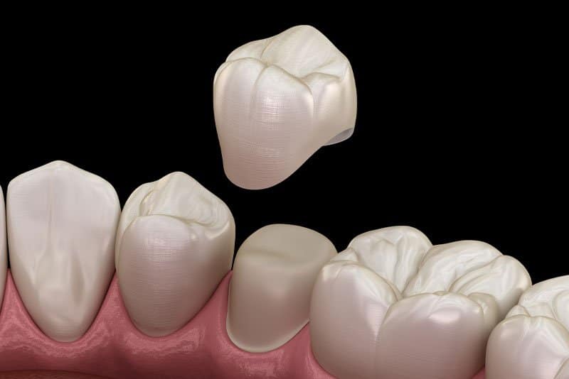 dental crowns model, Same-Day Crowns