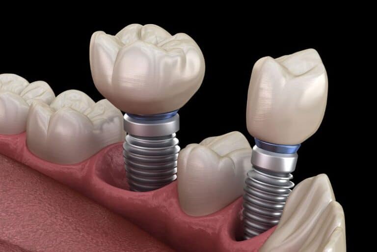 dental implants model 2, Are There Aesthetic And Functional Benefits To Getting Treated With Multiple Dental Implants?