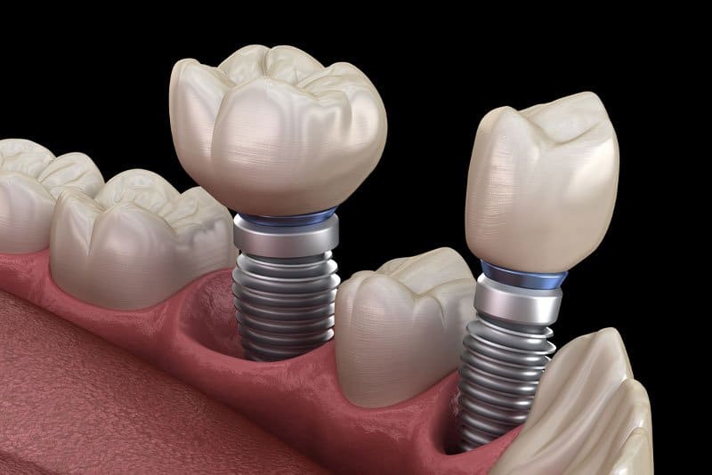 Photo for Are There Aesthetic And Functional Benefits To Getting Treated With Multiple Dental Implants?