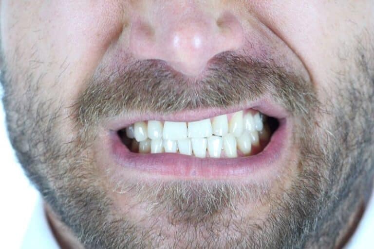 dental patient grinding his teeth, Night Guard for Bruxism: Dentist's Process