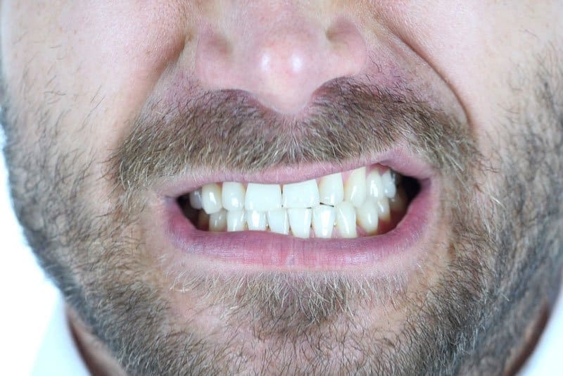 Photo for Night Guard for Bruxism: Dentist’s Process
