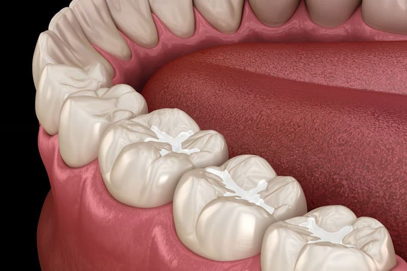 Photo for Should I Get Treated With Tooth Sealant?