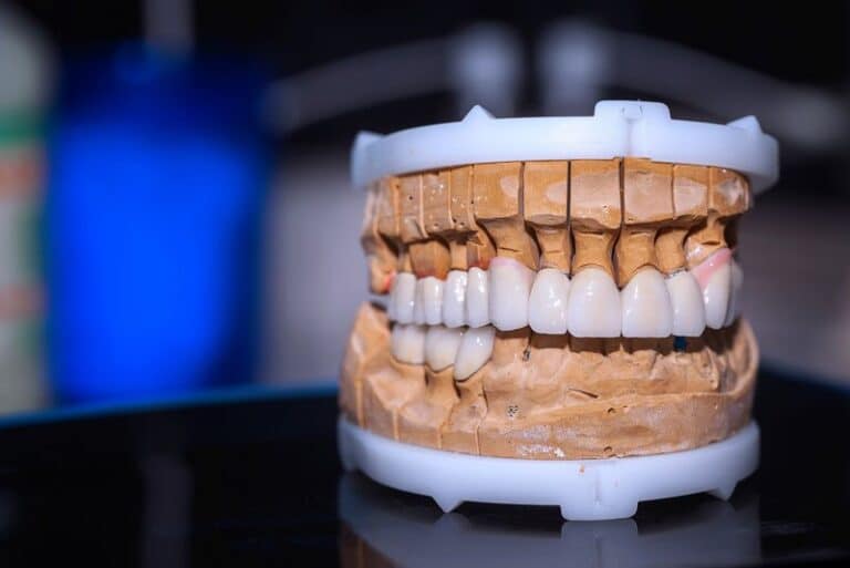 full arch implant model, Am I Able To Have A Full Arch Of Missing Or Damaged Teeth Replaced?