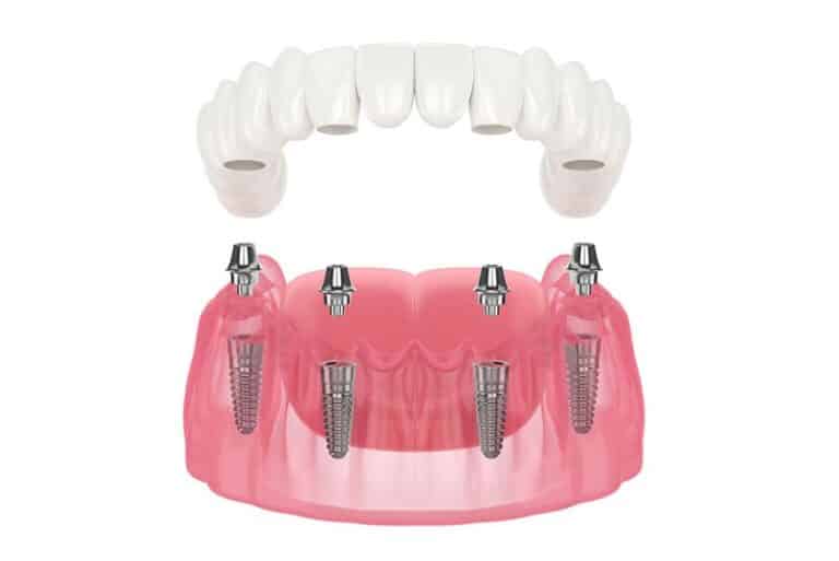 full mouth dental implant prosthetic, Symptoms That Can Be Treated With Implant Supported Dentures