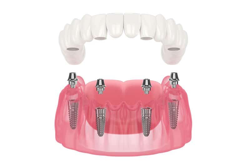 Photo for Symptoms That Can Be Treated With Implant Supported Dentures