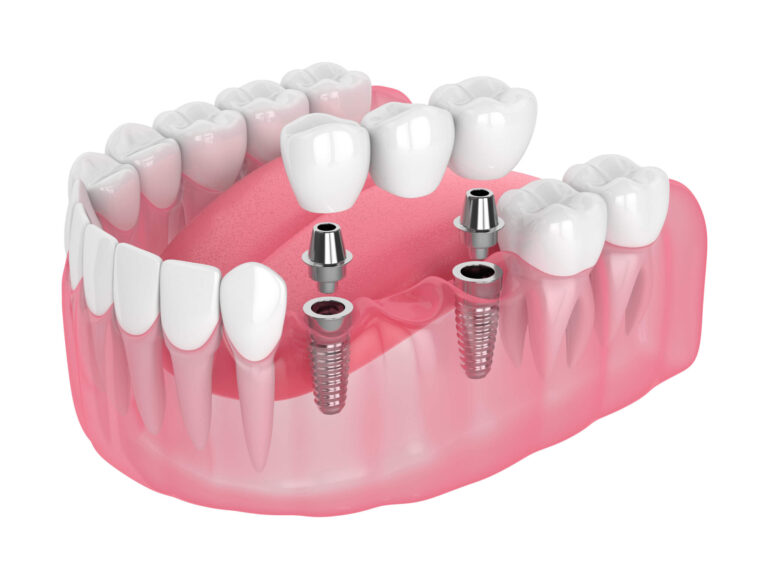 iStock 1154821208 scaled 1, Dental Implants v. Bridges