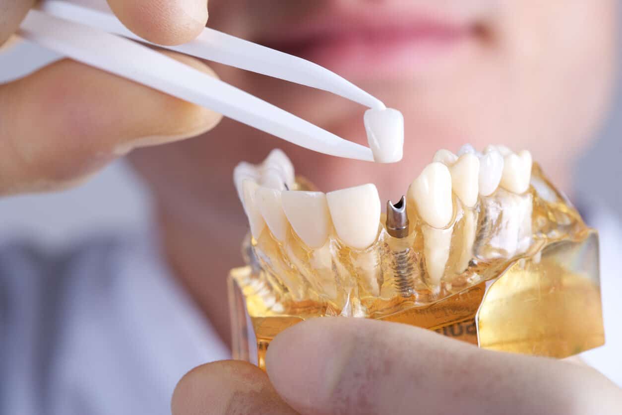 iStock 4716713251, Dental Implant Consultations