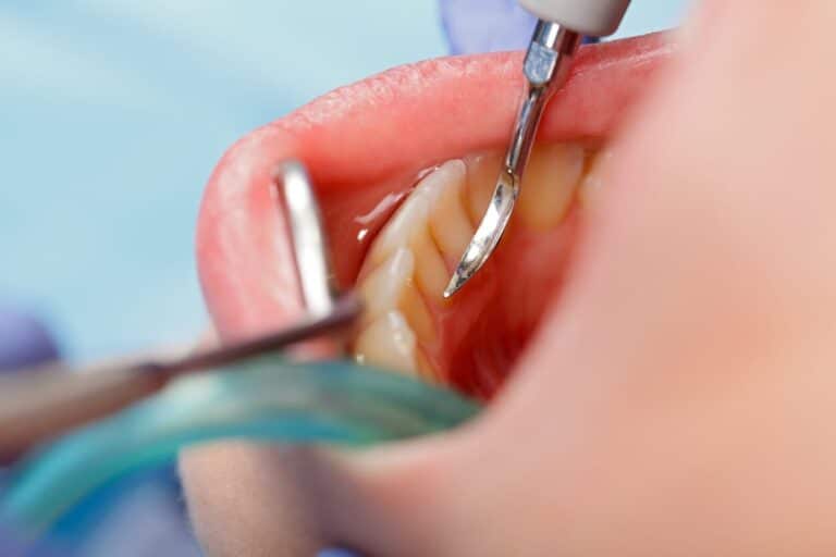 iStock 5097856811, Periodontal Therapy in Harris County, GA Saves Smiles!