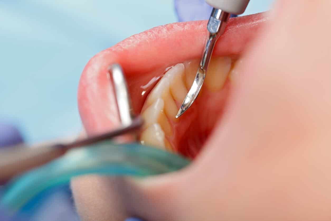 Photo for Periodontal Therapy in Harris County, GA Saves Smiles!
