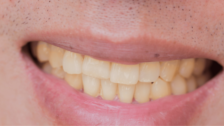 image1 min 15, Foods That Cause Teeth Stains