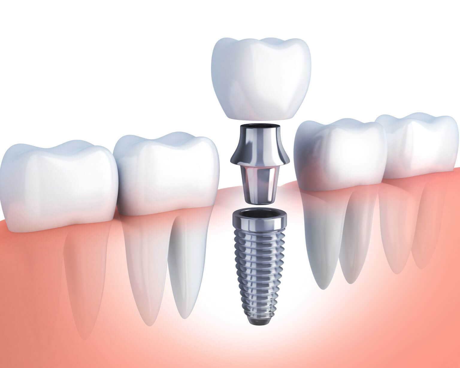 Photo for How to Prepare for Your First Dental Implant Placement