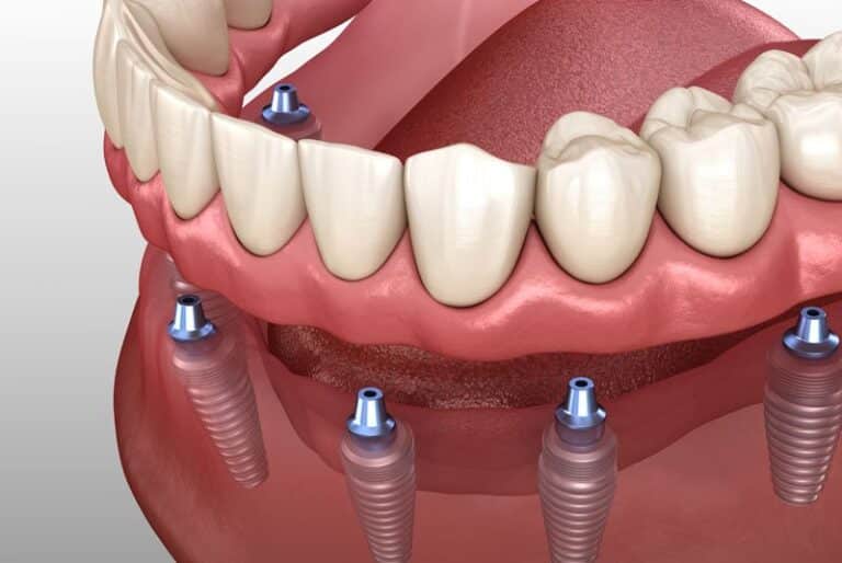 implant supported dentures graphic, Will Implant Supported Dentures Give Me A More Stable Smile Than Traditional Dentures?