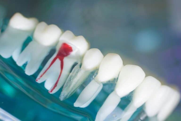 root canal model 2, Should I Go To A Doctor For A Root Canal Procedure?