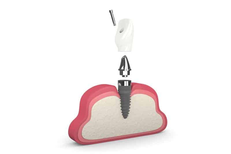 Photo for What Are The Benefits Of Dental Implants?
