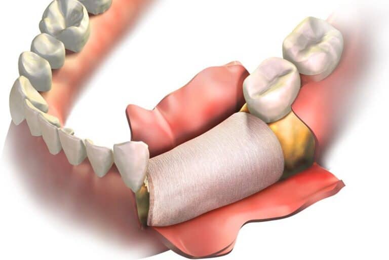 skin being pulled back to reveal a bone graft, Should I Get Dental Implants After A Bone Grafting Procedure?