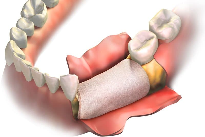 Photo for Should I Get Dental Implants After A Bone Grafting Procedure?