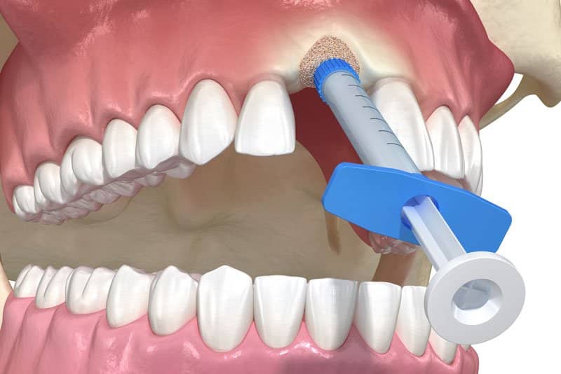socket preservation bone graft, Bone Grafts