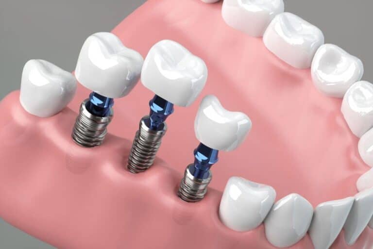 three single dental implants, How Many Teeth Can Dental Implants Replace?