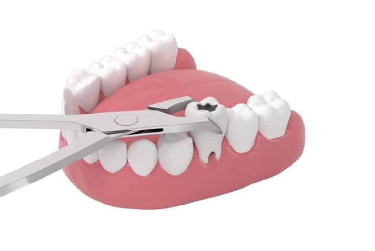 tooth extraction, Following A Tooth Extraction, What Should I Do?