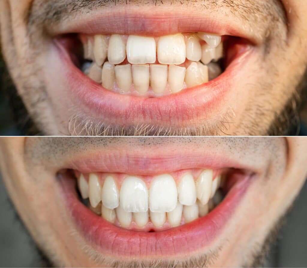 before and after man, Smile Makeovers