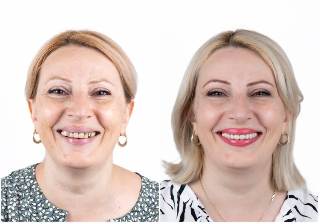 before and after woman, Smile Makeovers