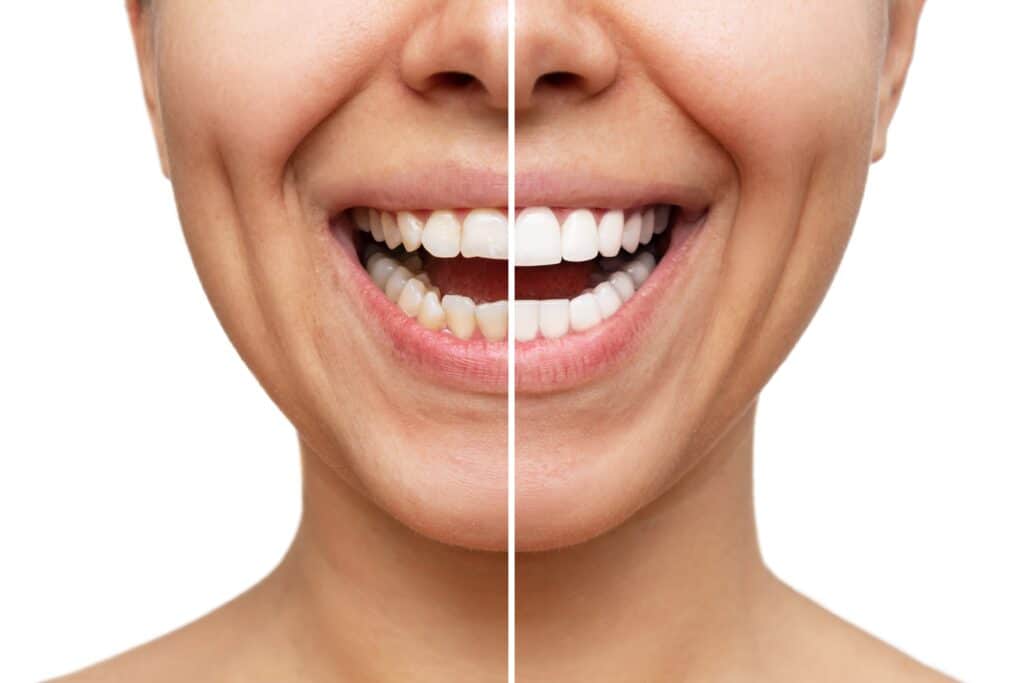 good candidate veneer, Porcelain Veneers