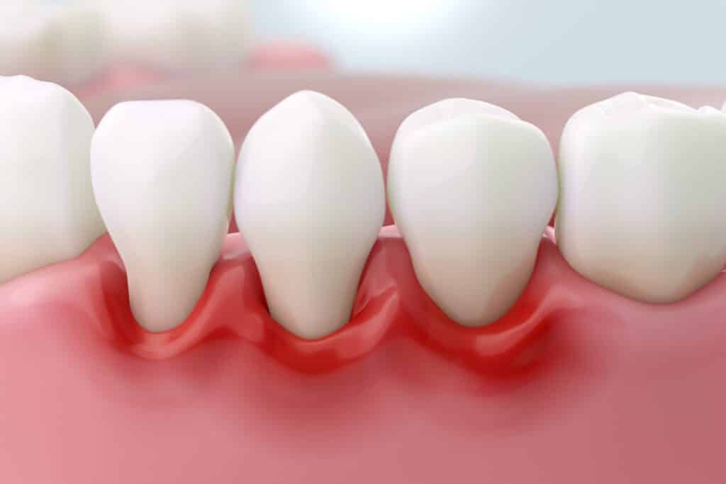 gum disease, Periodontal Disease Treatment