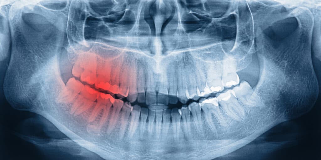 mouth xray pain, Root Canals